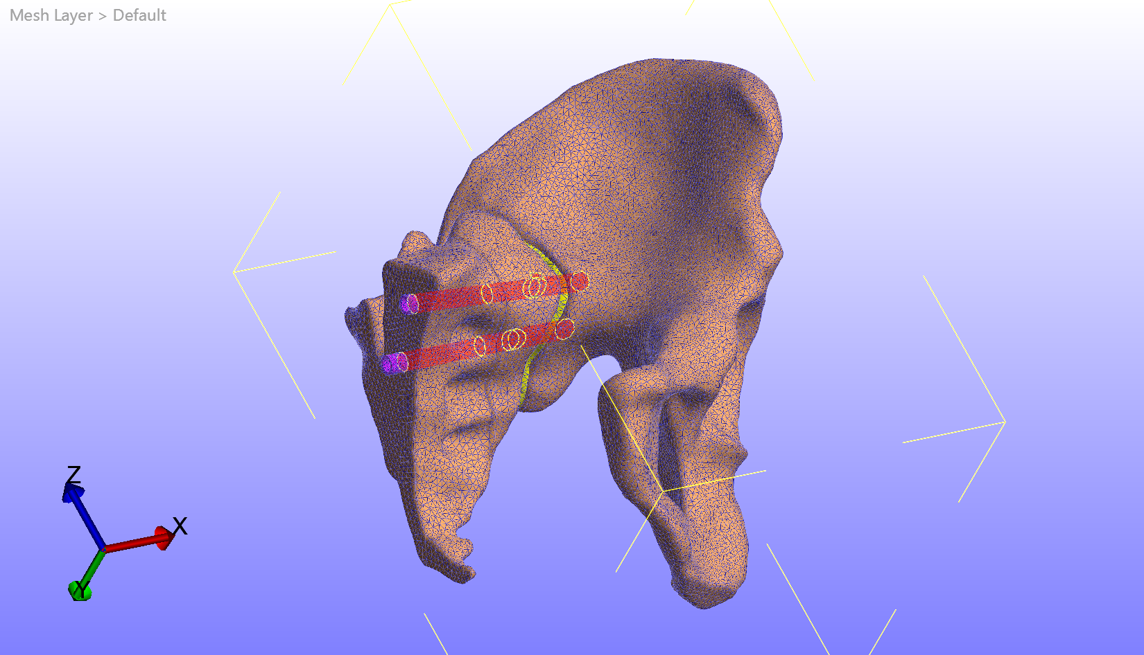 Finite Element Modeling of Pelvic Fracture Fixation